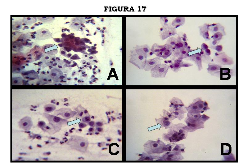 Figura 17. Fotomicrografias mostrando critrios citolgicos (setas) pr-malignos, de pleomorfismo, quebra da relao ncleo-citoplasma, hipercromasia e irregularidades da membrana nuclear, associados a Leses intra-epiteliais escamosas de alto grau (HSIL), e observados pelos mtodos de Citologia Convencional (A e C) ou, confirmado, pelo mtodo de Citologia de Base Lquida (B e D).